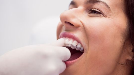 Aparat Clear Aligner – wskazania i przeciwwskazania do stosowania