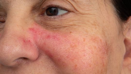 Suchość i łuszczenie się skóry – problemy z nawilżeniem przy trądziku różowatym