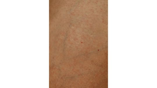 Zmiany rubinowe – skąd się biorą i czy trzeba je usuwać?