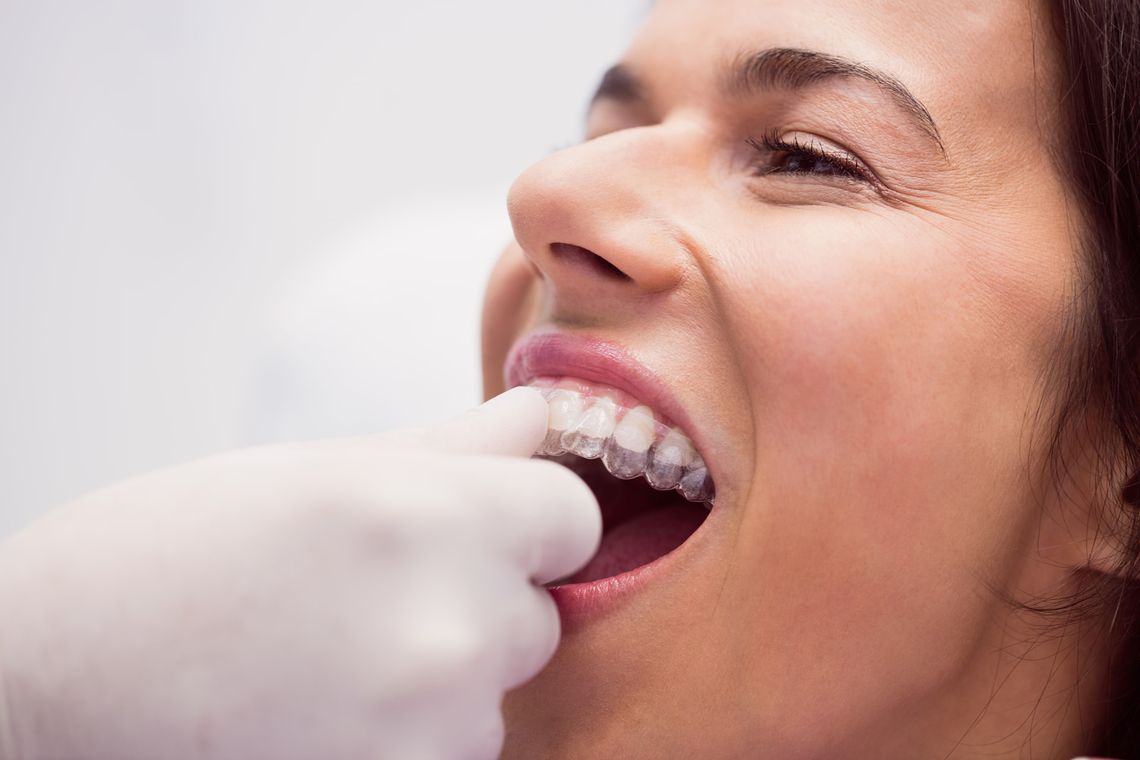 Aparat Clear Aligner – wskazania i przeciwwskazania do stosowania Aparat Clear Aligner – wskazania i przeciwwskazania do stosowania
