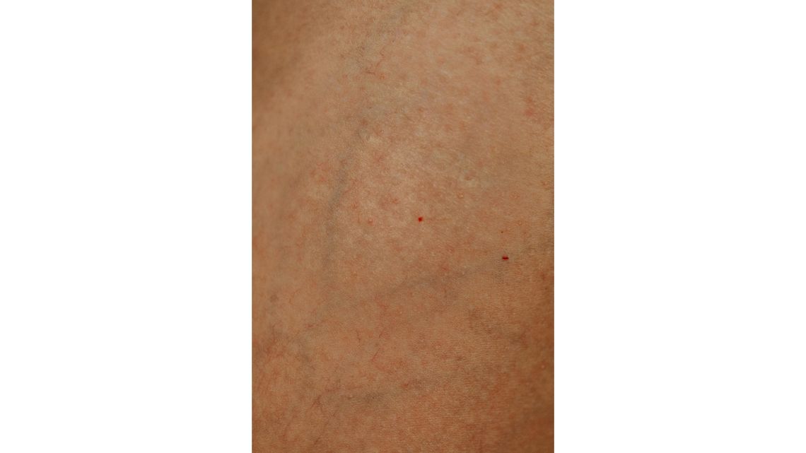 Zmiany rubinowe – skąd się biorą i czy trzeba je usuwać?